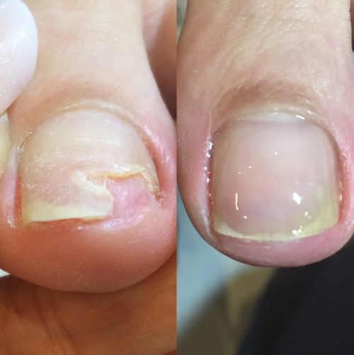 04-5　剥離　育成前・結果